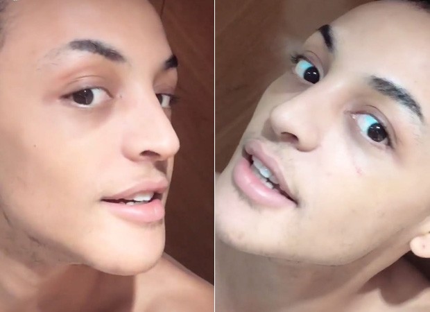 A drag queen Pabllo Vittar exibeo resultado de cirugia no nariz