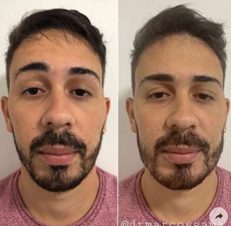 Antes e Depois da harmonização facial de Carlinhos Maia 