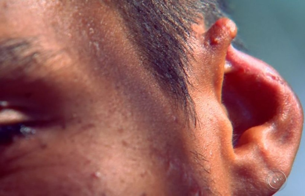 Jonathan teve parte da orelha arrancada durante a agressão (Foto: Reprodução / TV TEM )