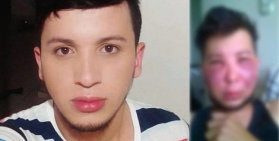 O colombiano ficou com o rosto desfigurado, após intervenção estética