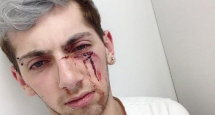 Joe Clarke exibe rosto machucado após agressão homofóbica
