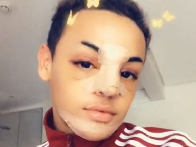 A drag queen Pabllo Vittar exibe curativos de cirurgia no nariz