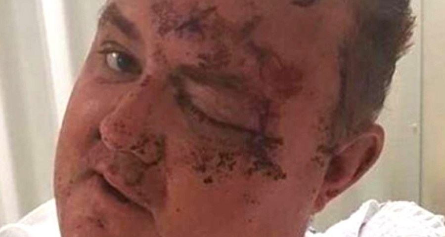 Médico gay sofre fratura craniana após ataque homofóbico ao sair de bar LGBT na Austrália