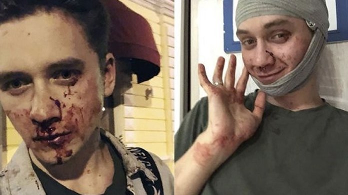 O Ucraniano NIkita Ponarim logo após o ataque homofóbico e depois de ser atendido no hospital