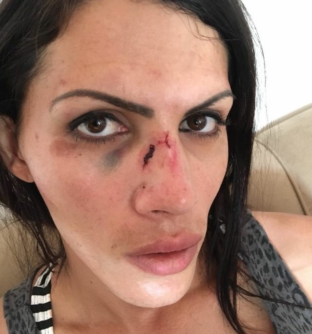 Transexual exibe ferimentos sofridos após agressão durante assalto em MT