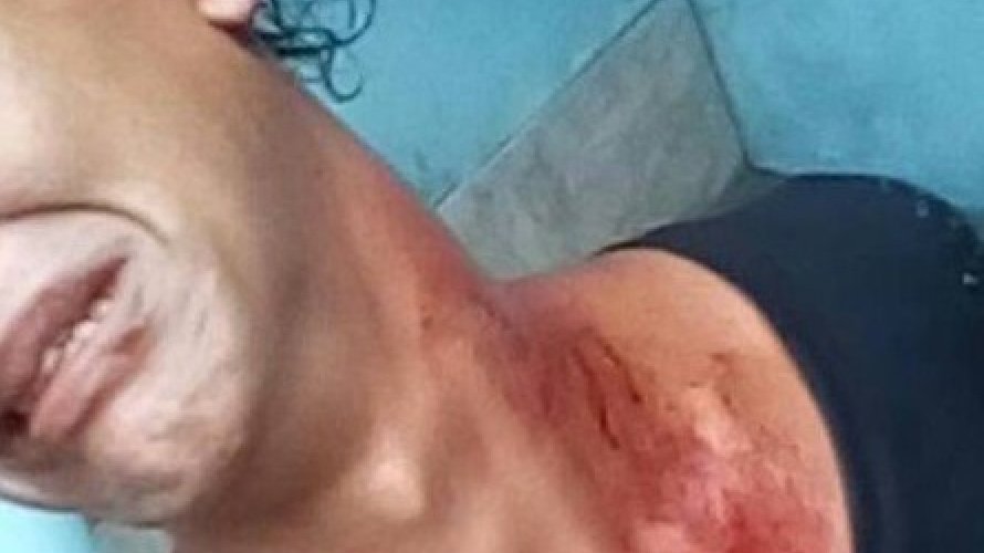 Técnica de enfermagem trans Julyana Barbosa exibe ferimentos da agressão