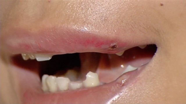 Travesti de 15 anos perde oito dentes após agressão em Rondonópolis