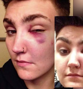 Emmit Davis, jovem trans norte-americano, exibe olho roxo após agressão