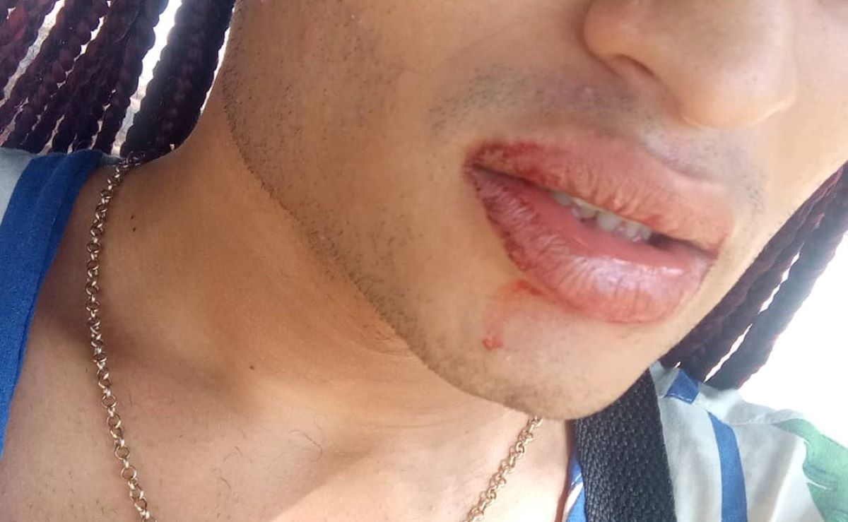 Kevin mostrou boca machucada após ser agredido no transporte público (Foto: Reprodução)
